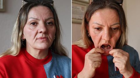 Diş ağrısı için gitti, 25 dişi birden çekildi