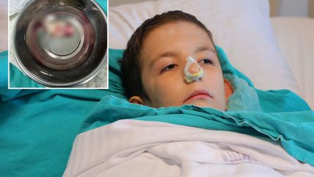 Kahramanmaraş'ta Burun Tıkanıklığı Olan Çocuğa Ameliyat Yapıldı