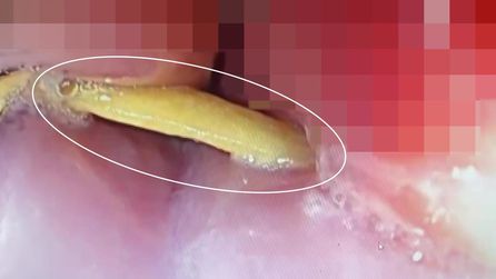 Bursa'da 5 cm'lik kemik parçası nedeniyle acil ameliyat yapıldı