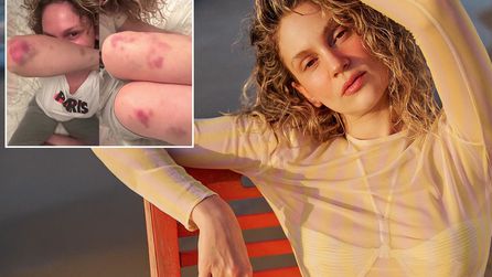 Farah Zeynep Abdullah'ın morlukları hayranlarını endişelendirdi