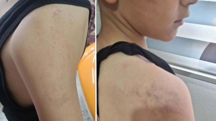 Yunusemre'de babası tarafından dövülen 12 yaşındaki çocuk hastaneye kaldırıldı