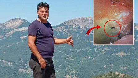 Aydın'da mide ağrısı çeken hastada böcek tespit edildi