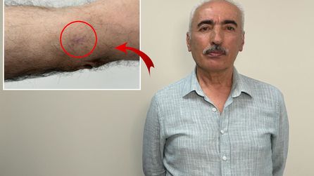 Güneş Maruziyeti Cilt Kanserine Yol Açabiliyor