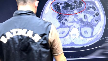 Yolcu otobüsünde uyuşturucu midesinden çıkarıldı