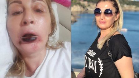 Estetik işlem sonrası doku kaybı yaşayan kadının hukuk mücadelesi sürüyor