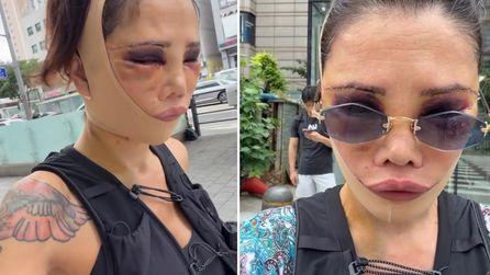 Didem Ceran estetik sonrası yeni açıklamalarda bulundu