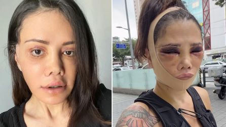 Didem Ceran yüz operasyonu sonrası sosyal medyada görüntü paylaştı