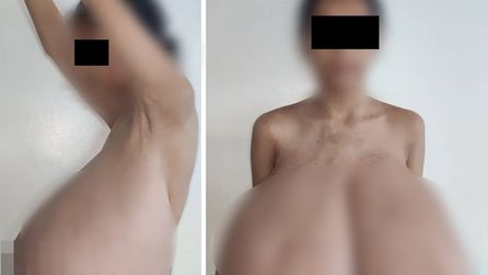 Fas'taki 15 yaşındaki kızda nadir hastalık nedeniyle göğüs büyümesi